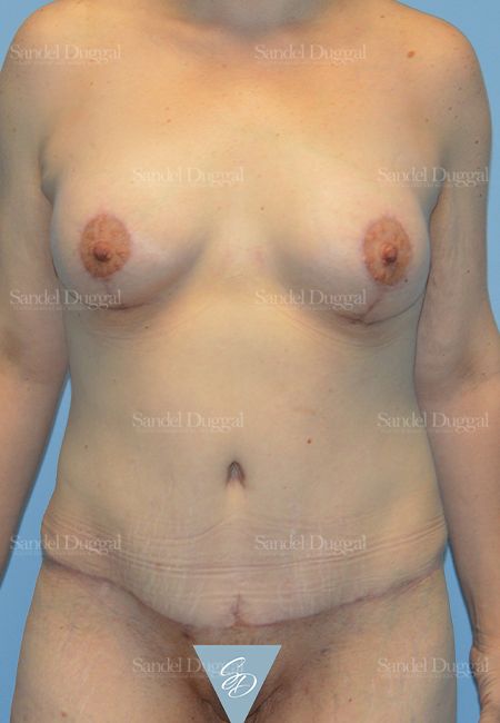 Mommy Makeover after, case 2211