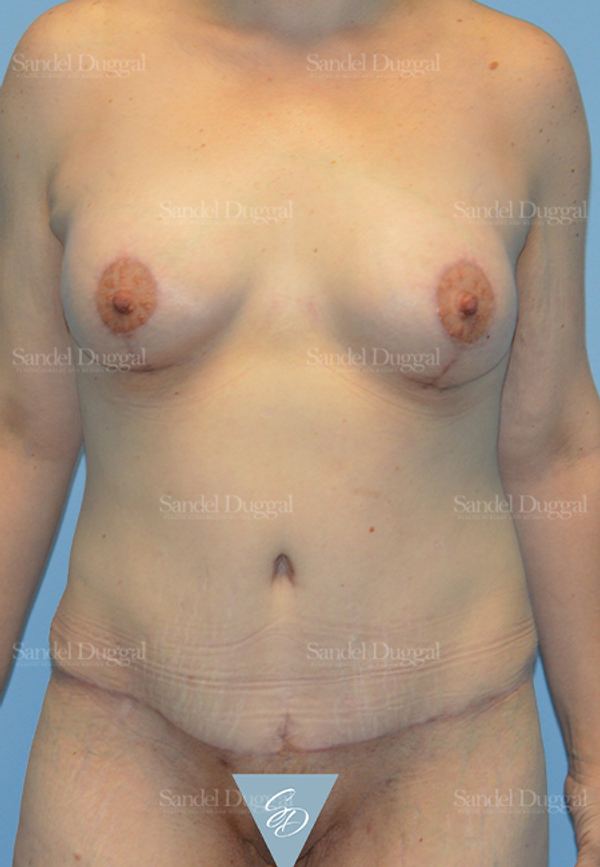 Mommy Makeover after, case 2211