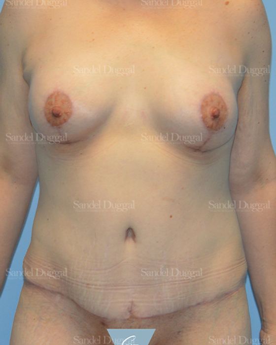 Mommy Makeover after, case 2211