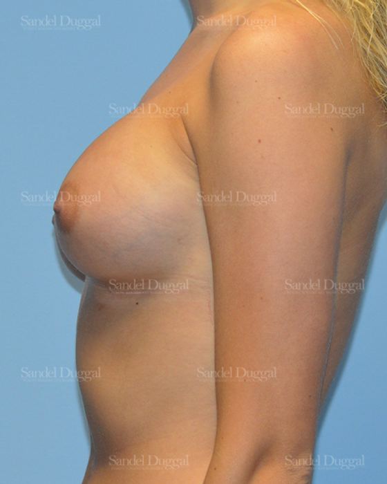 Breast Augmentation after, case 3080