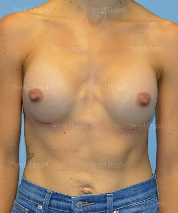 Breast Augmentation after, case 3087