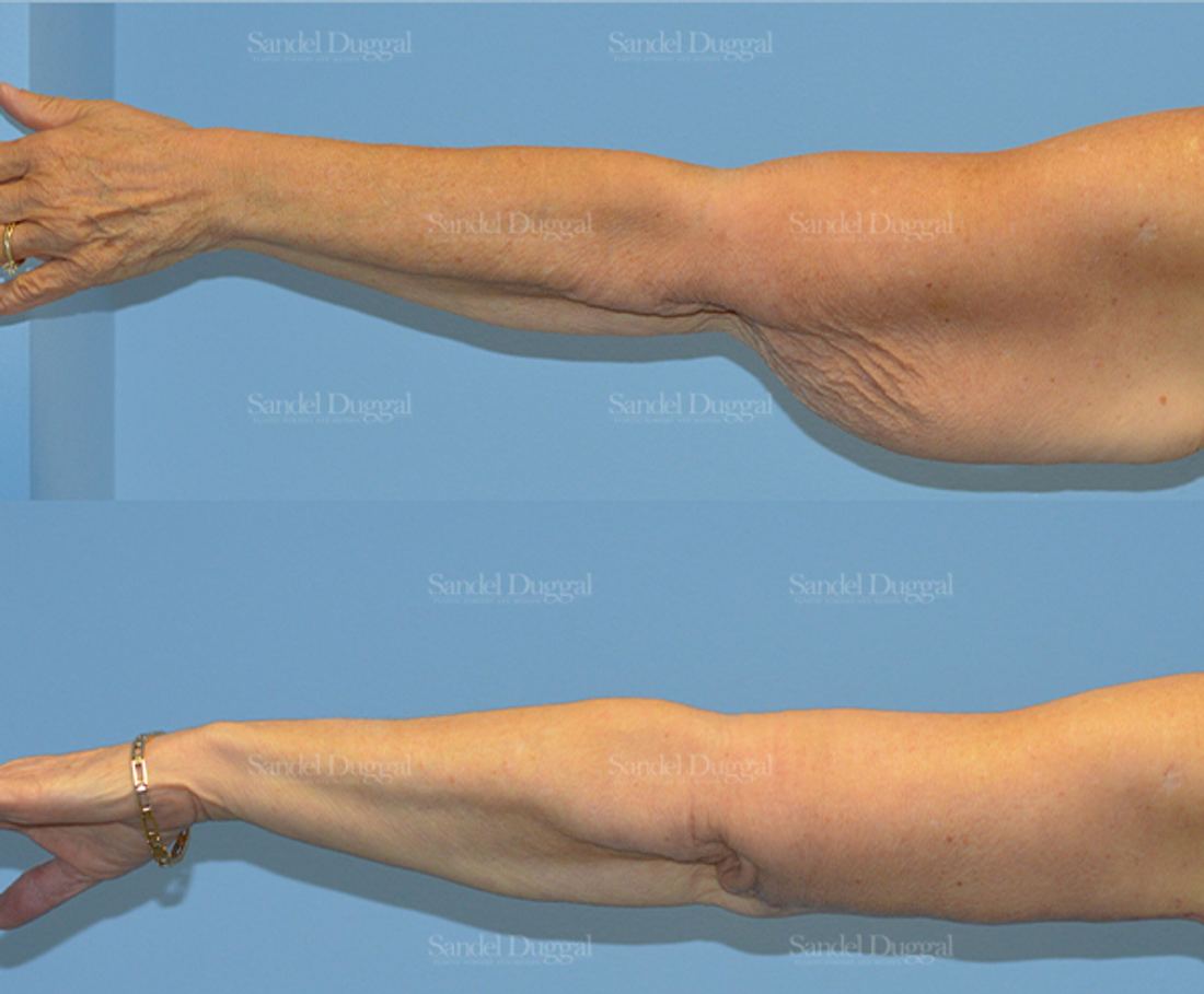 Brachioplasty before and after, case 2150