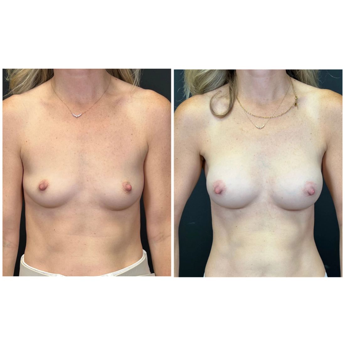 Motiva Preserve before and after, case preserve-06
