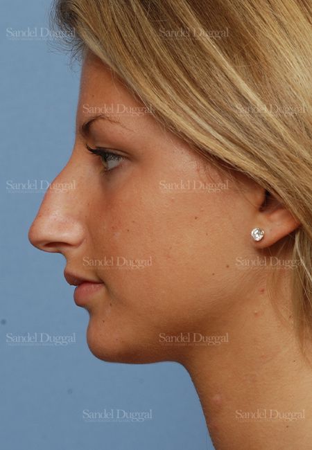 Rhinoplasty before, case 2876