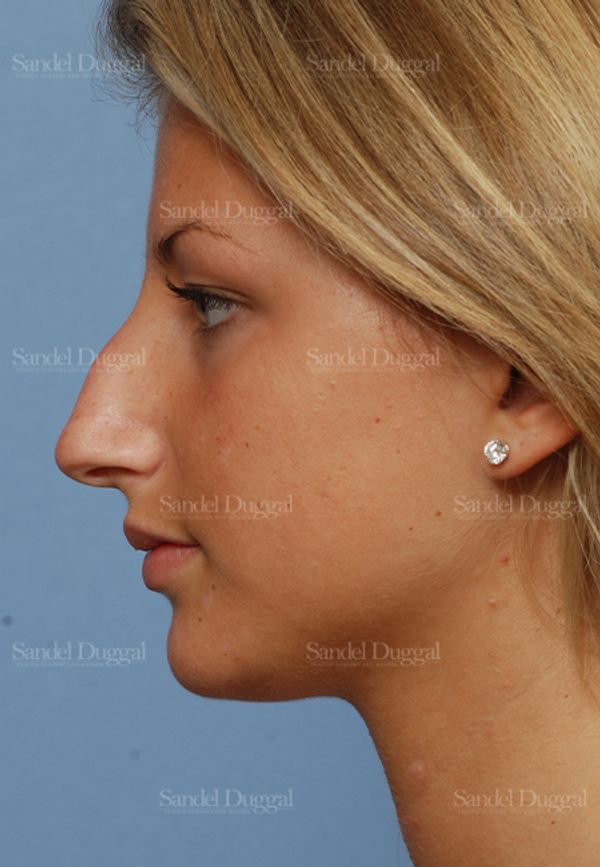 Rhinoplasty before, case 2876