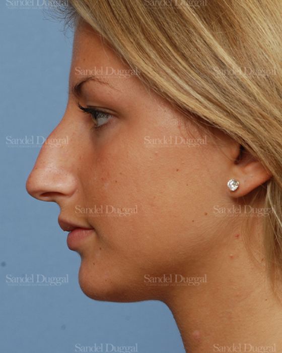 Rhinoplasty before, case 2876