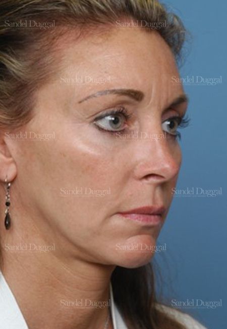 Chin Augmentation after, case 1484