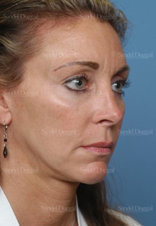 Chin Augmentation after, case 1484