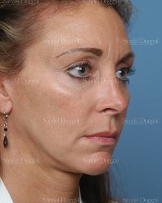 Chin Augmentation after, case 1484