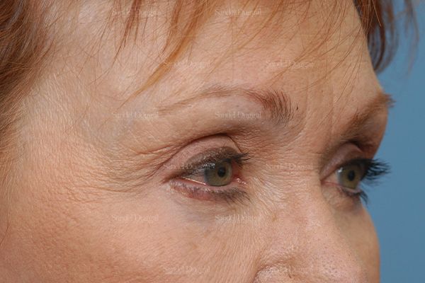 Eyelid Rejuvenation after, case 1930