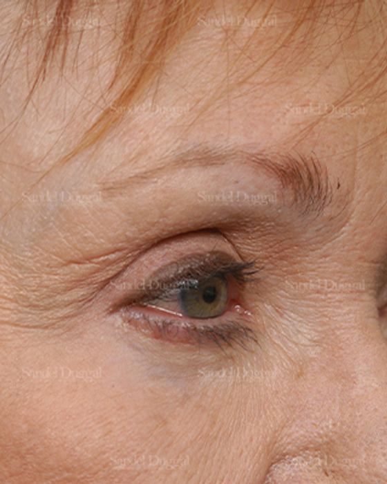 Eyelid Rejuvenation after, case 1930