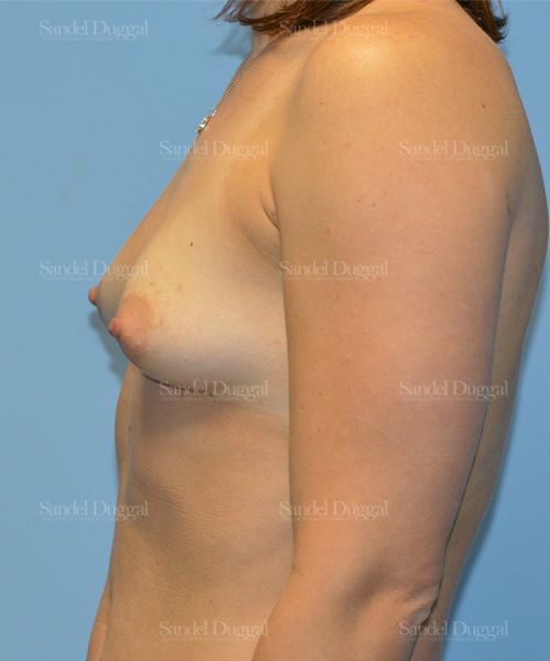 Breast Augmentation before, case 3213
