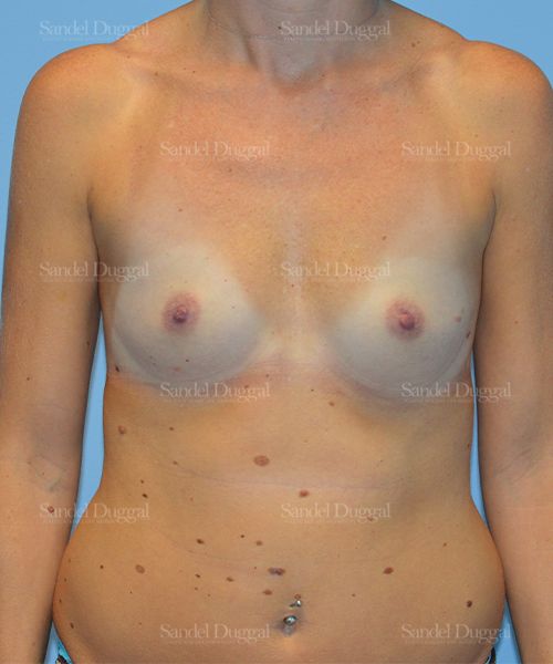 Breast Augmentation before, case 771