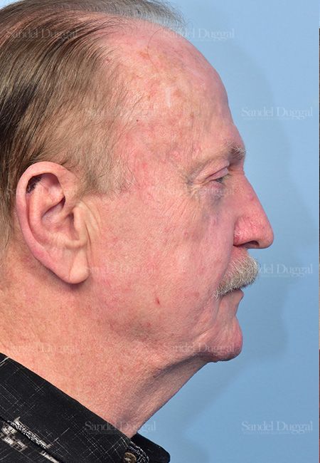 Facelift before, case 5748