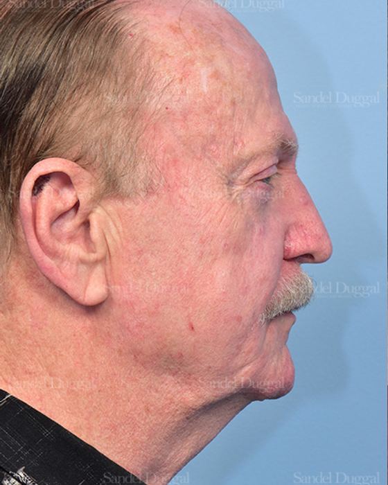 Facelift before, case 5748