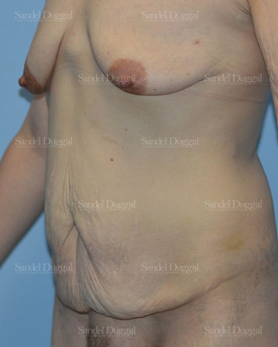 Tummy Tuck before, case 1615