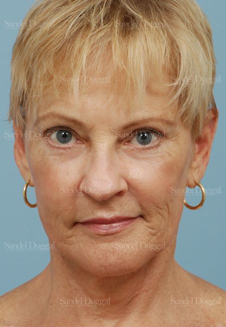 Laser Skin Resurfacing after, case 2958