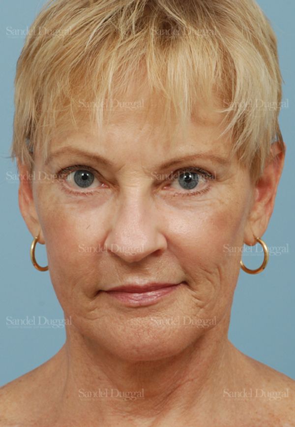Laser Skin Resurfacing after, case 2958