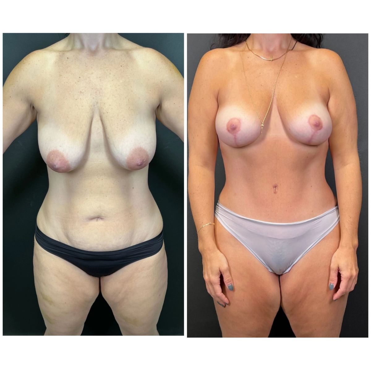 Mommy Makeover before and after