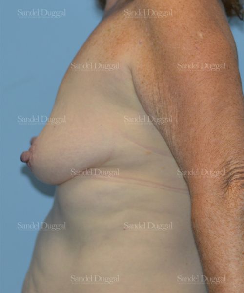 Breast Augmentation with Lift before, case 3365