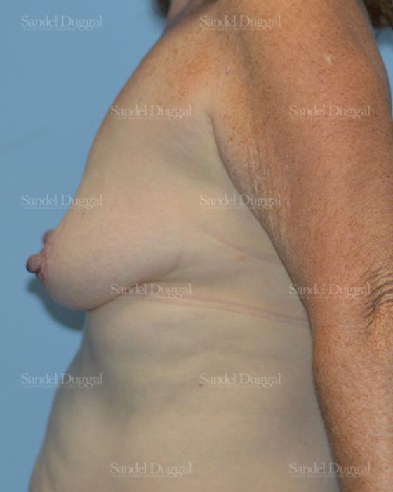 Breast Augmentation with Lift before, case 3365