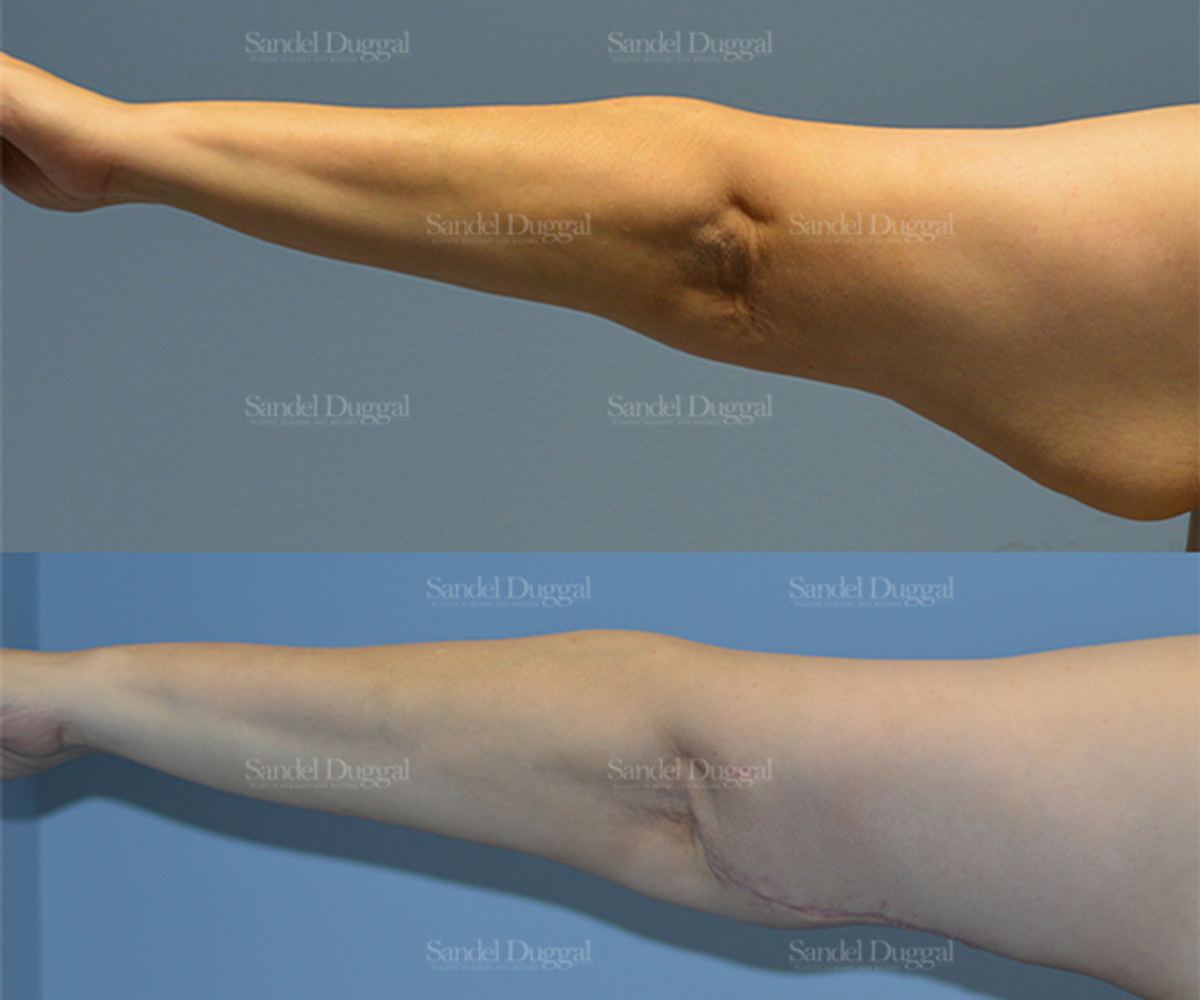 Brachioplasty before and after, case 2134