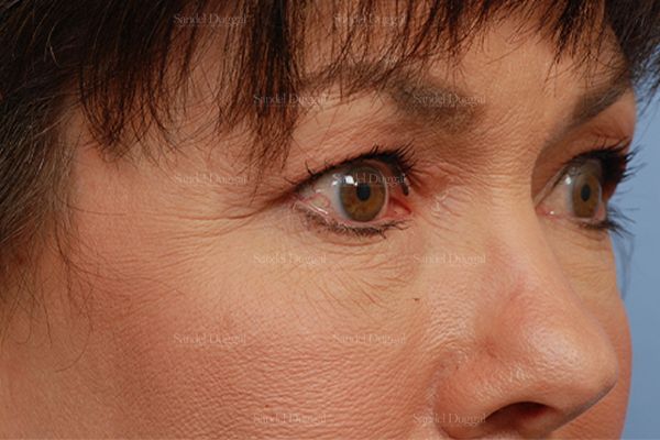 Eyelid Rejuvenation before, case 1971