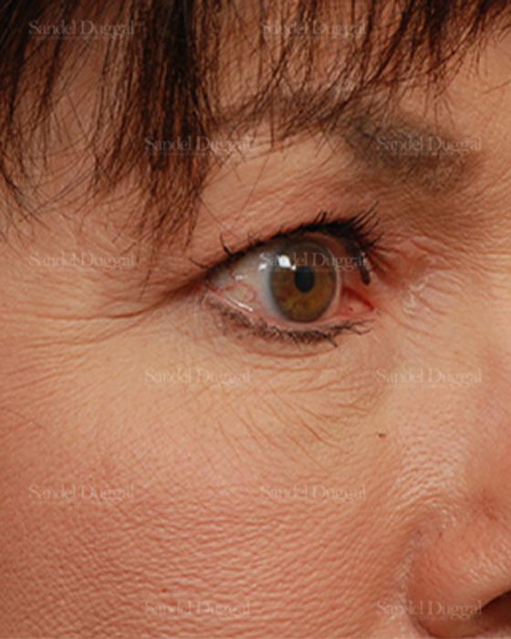Eyelid Rejuvenation before, case 1971