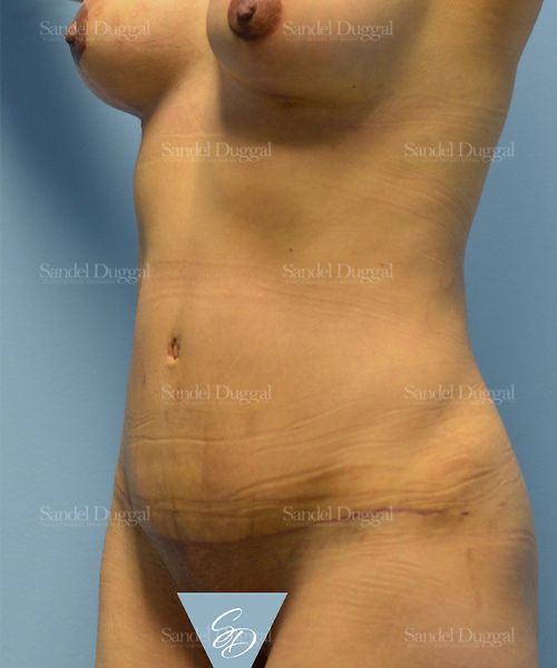 Tummy Tuck after, case 1580