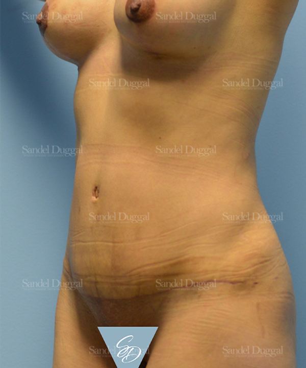 Tummy Tuck after, case 1580