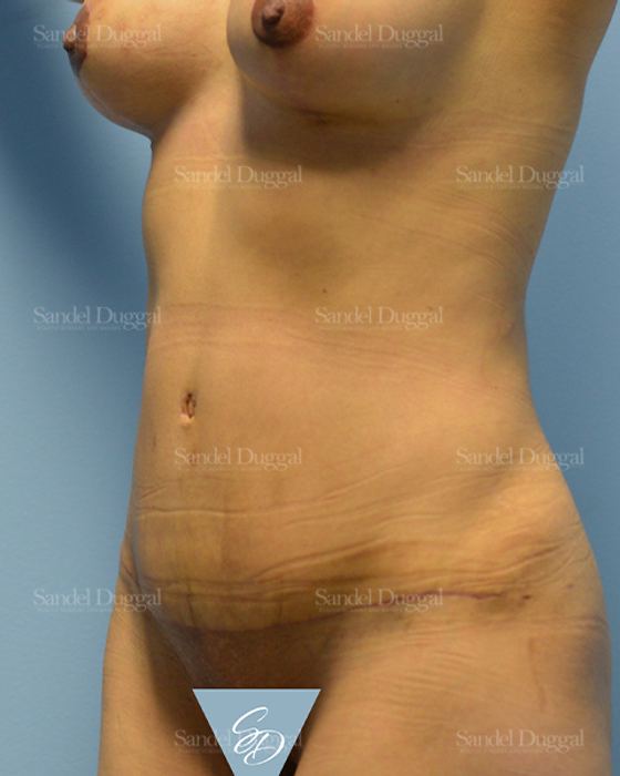Tummy Tuck after, case 1580