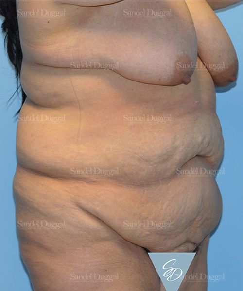 Tummy Tuck before, case 1547