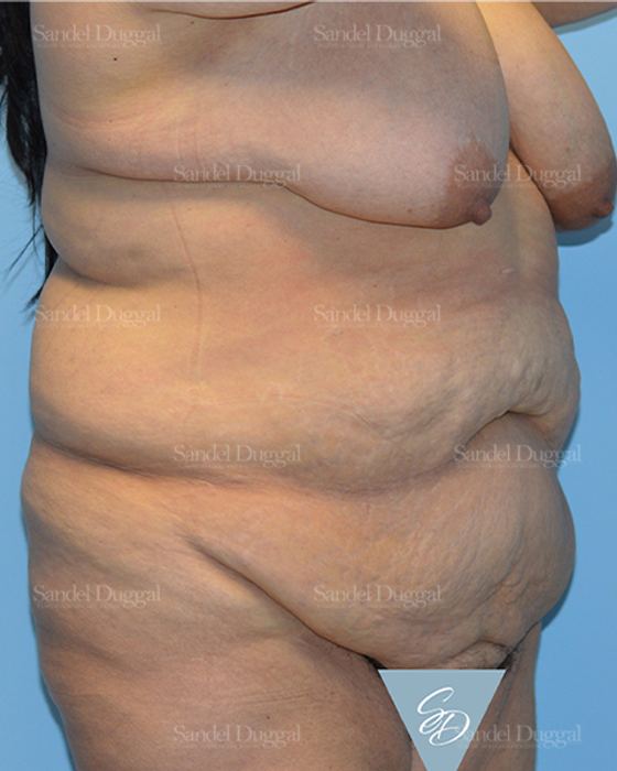 Tummy Tuck before, case 1547