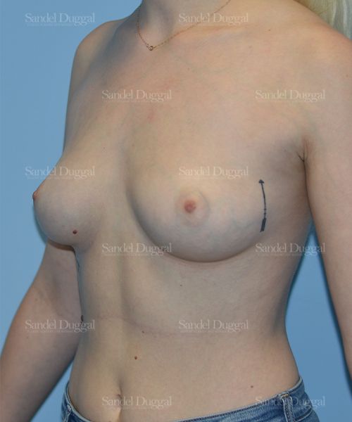 Breast Augmentation before, case 3129