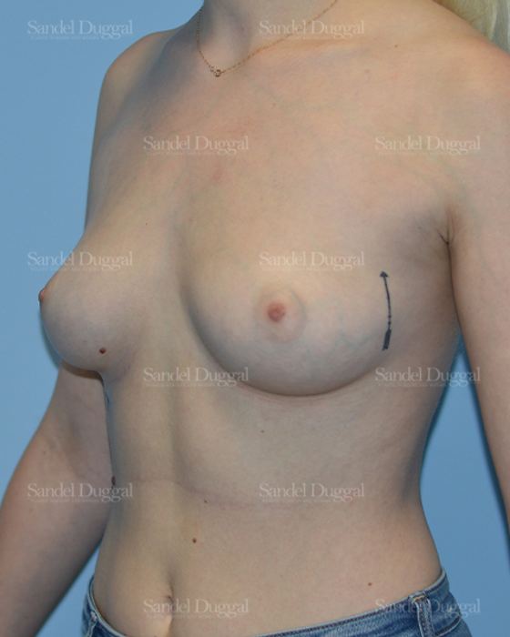 Breast Augmentation before, case 3129