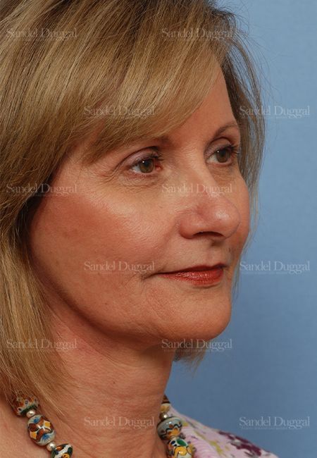 Facelift after, case 2702
