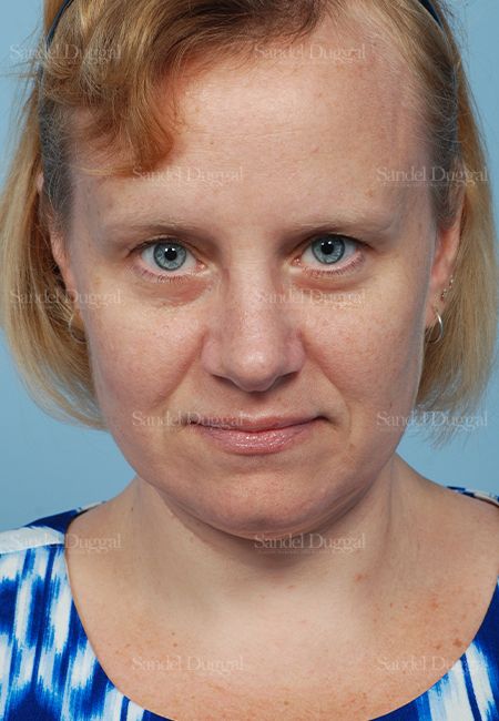 Rhinoplasty after, case 2862