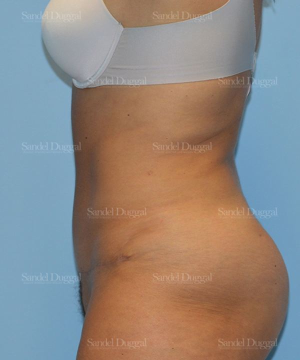 Tummy Tuck after, case 1526