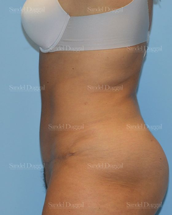 Tummy Tuck after, case 1526