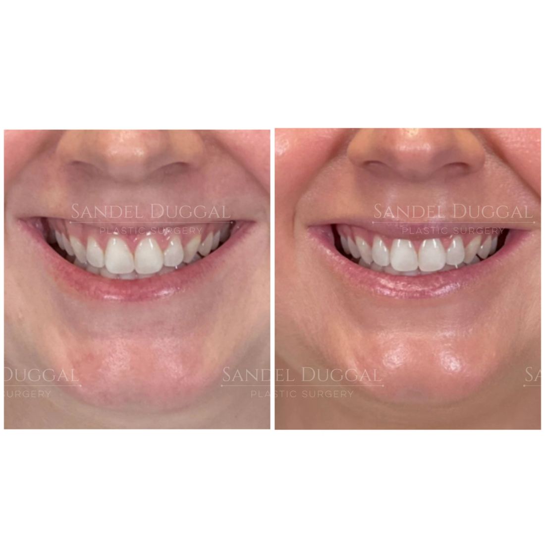 Botox & Fillers before and after, case 6006