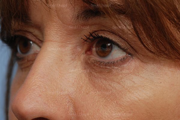 Eyelid Rejuvenation after, case 831