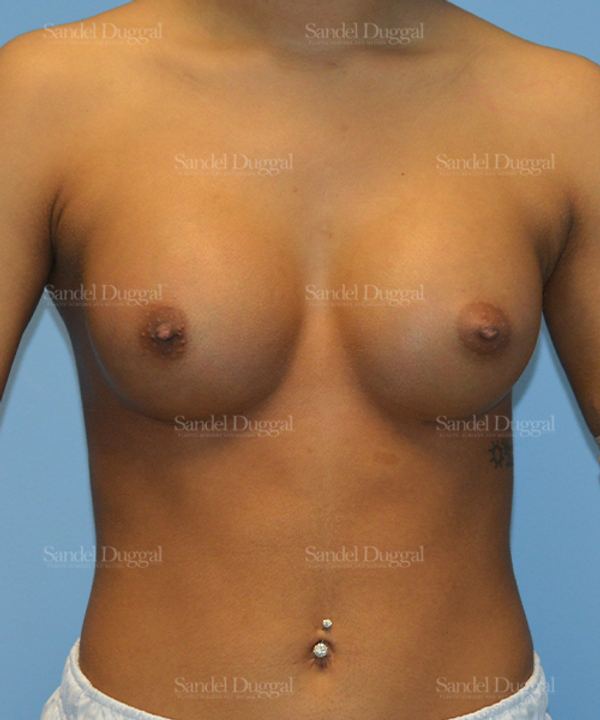 Breast Augmentation after, case 3164
