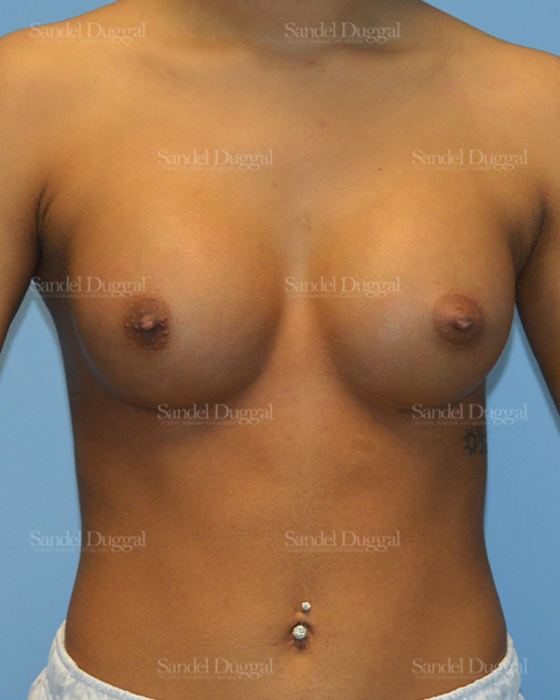 Breast Augmentation after, case 3164