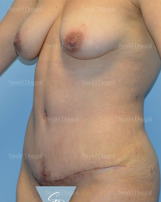 Tummy Tuck after, case 1643