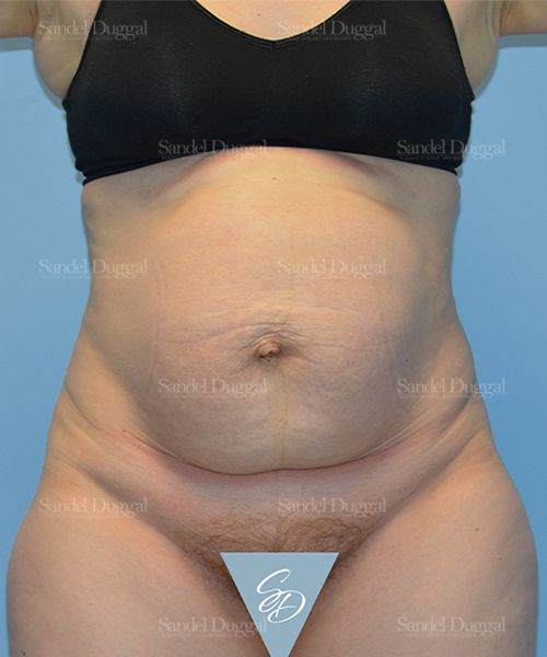 Tummy Tuck before, case 1666
