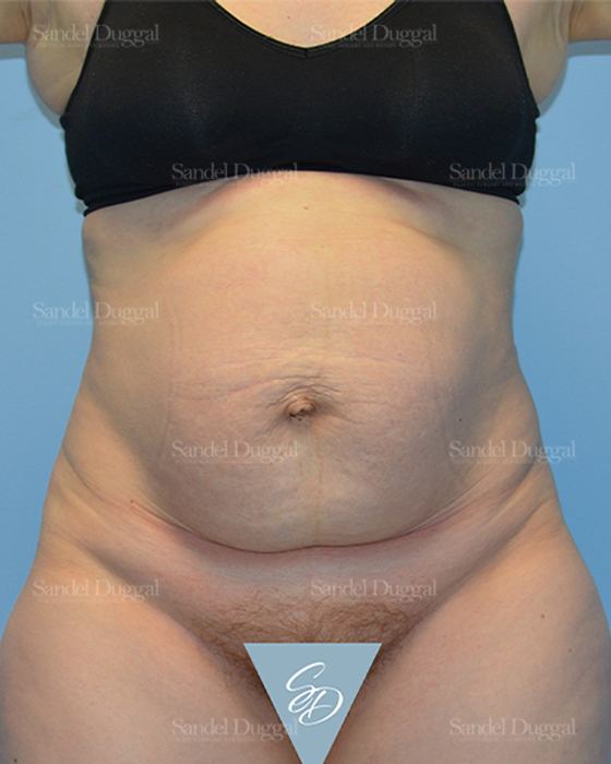 Tummy Tuck before, case 1666