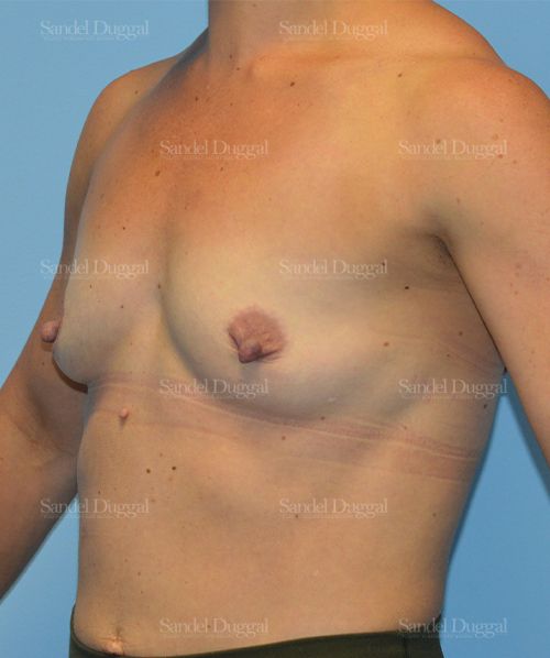 Breast Augmentation before, case 3115