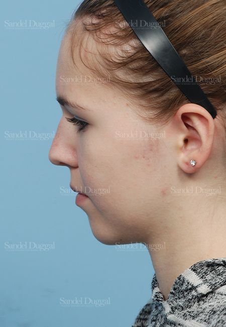 Otoplasty after, case 2598