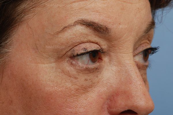 Eyelid Rejuvenation before, case 831