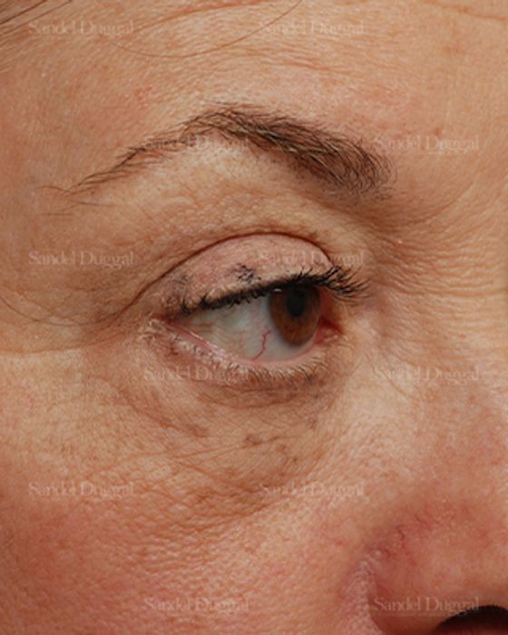 Eyelid Rejuvenation before, case 831